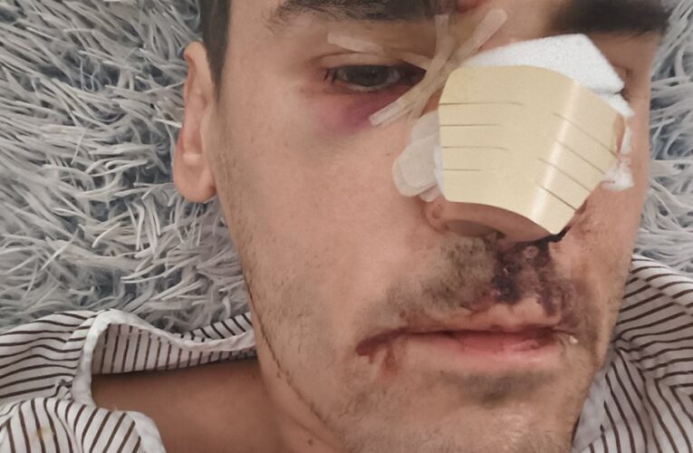 España no es país para denunciantes: Todo el apoyo a Fonsi Loaiza tras su brutal agresión